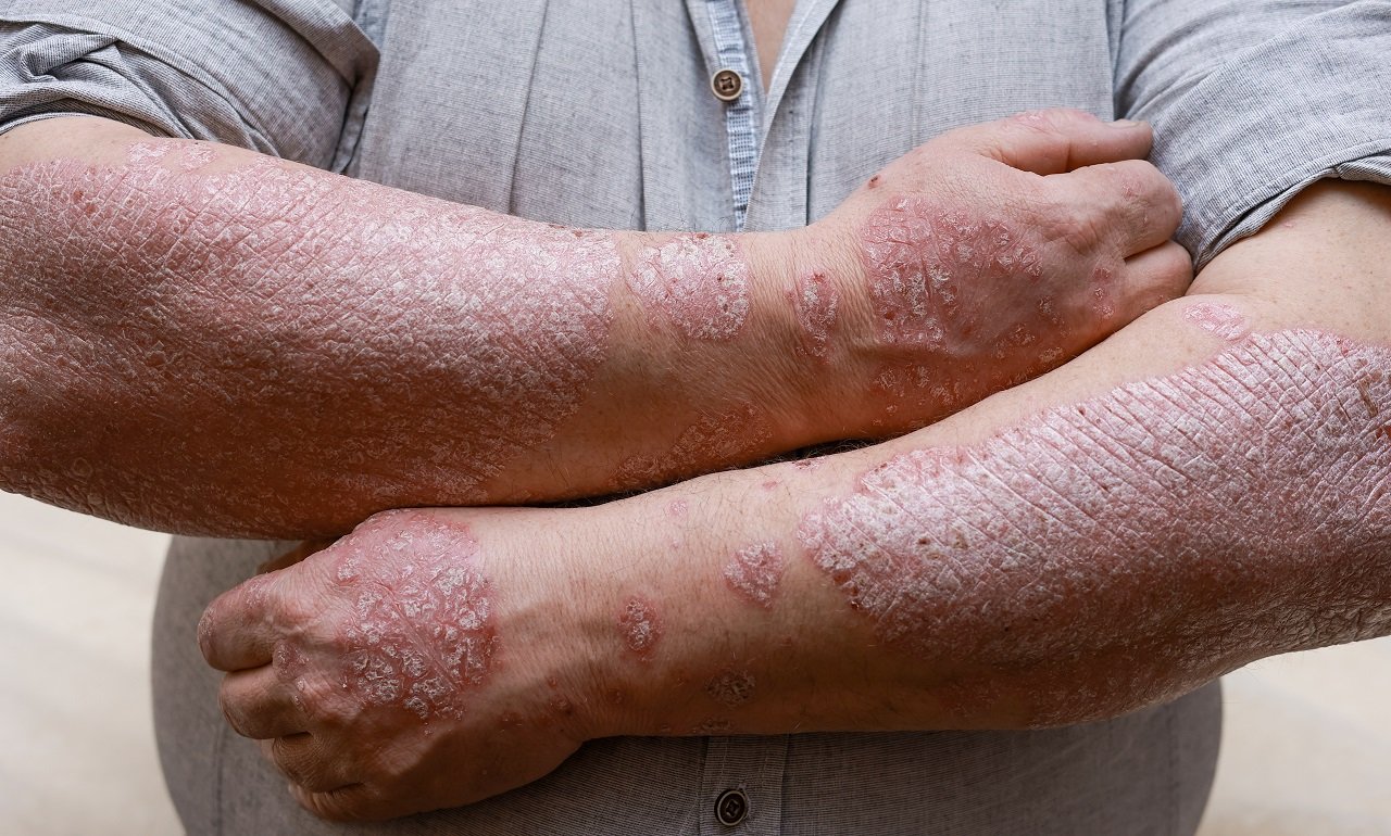 psoriasis skin with red wounds male arms with cra 2024 10 21 18 03 27 utc