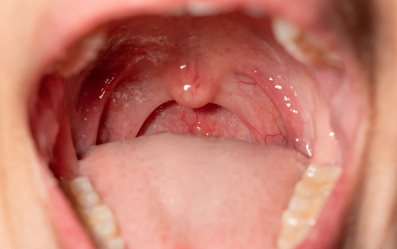 sore throat with throat swollen closeup open mout 2023 11 27 05 04 59 utc